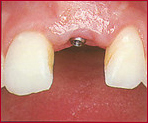 Dr. Flach, Zahnarzt Wuppertal - Zahn Implantat