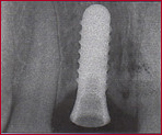 Dr. Flach, Zahnarzt Wuppertal - Zahn Implantat