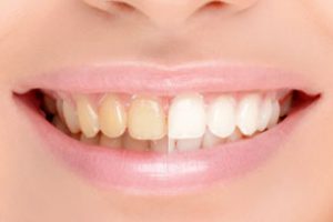 Schönere Zähne durch Zahnaufhellung in Wuppertal Dr. Flach